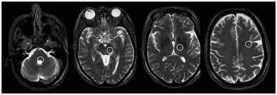 Case report: Left gaze and facial nerve palsies after ventral intermediate thalamic nucleus deep brain stimulation implantation